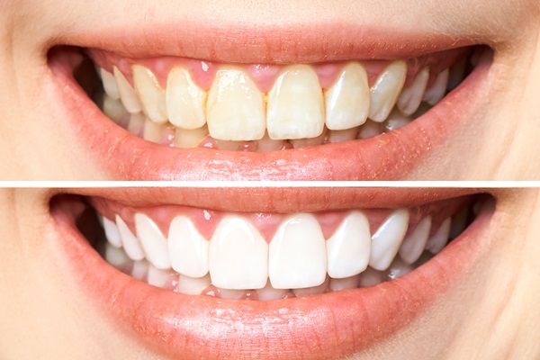 Professional teeth whitening treatment near me in Elgin, TX.