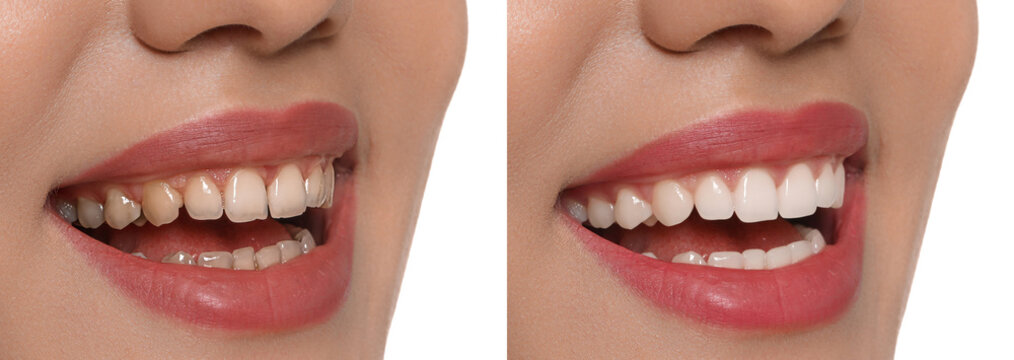 Before and after porcelain veneers from a friendly, family dentist in Elgin, TX.