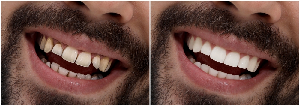 Before and after porcelain veneers from a friendly, cosmetic dentist in Elgin, TX.