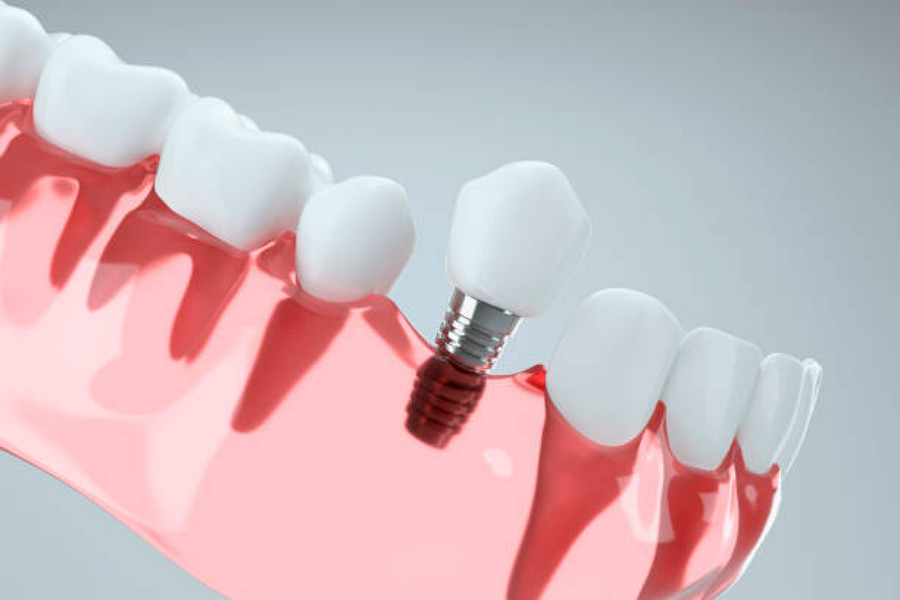 Are you a candidate for dental implants in Elgin, TX? Visit our dental office to learn more.