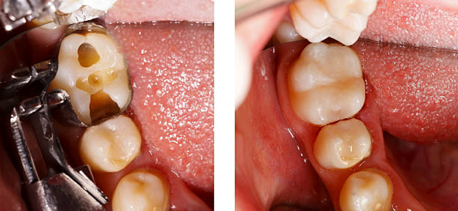 Before and after a dental filling procedure in Elgin, TX.