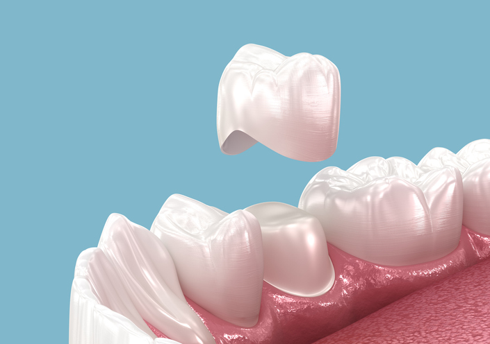 Get dental crowns from your #1 Elgin, TX family dentist.