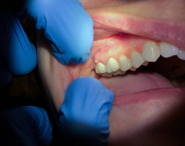 Effective Dental Abscess Treatments in Elgin, TX
