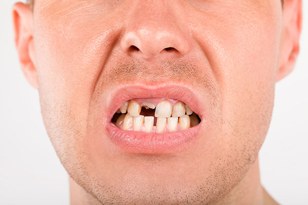 Are you a candidate for dental implants in Elgin, TX? Visit our dental office to learn more.